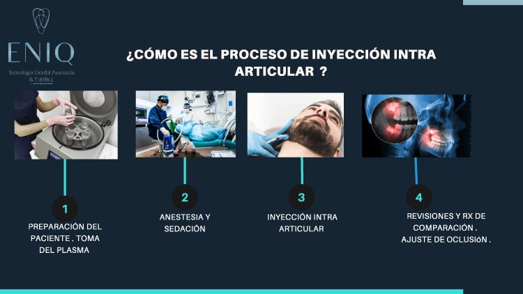 Intra-articular injection procedure