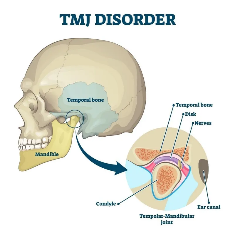 Articulación temporomandibular (ATM) - Anatomía del trastorno TMJ con hueso temporal, disco, nervios y cóndilo